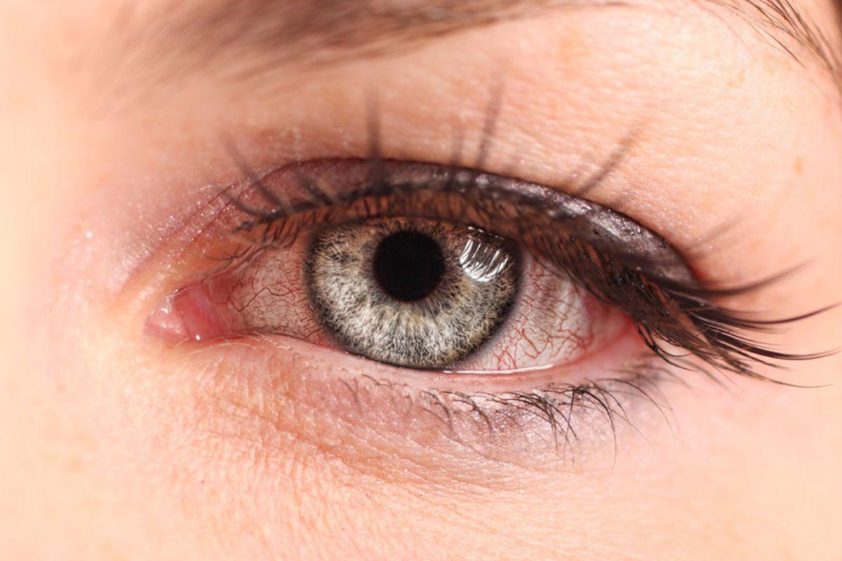 Een virus in het oog